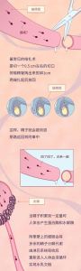 男人结扎还能挽回吗，结扎后想再生娃？手术有风险，权衡再决定！